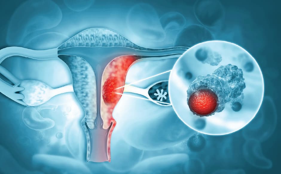 Is Endometrial Cancer Hereditary? Genetics, Risk Factors and Warning Signs