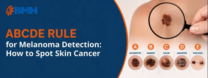 ABCDE Rule for Melanoma Detection 1